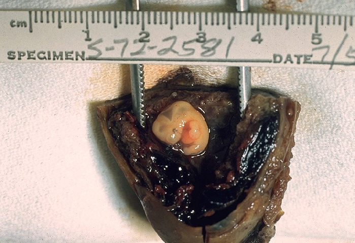 File:Tubal pregnancy, gross pathology 01ee049 lores.jpg