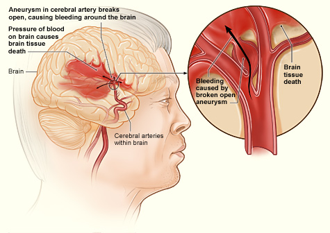 Archivo:Stroke hemorrhagic.jpg