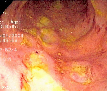 File:CD colitis.jpg