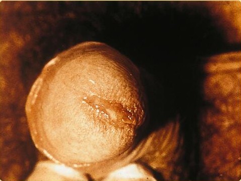 File:SOA-Chlamydia-trachomatis-male.jpg