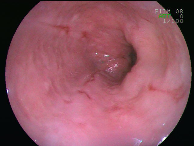 File:Esophageal ulcer.jpg