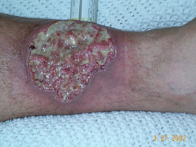 File:Crohnie Pyoderma gangrenosum.jpg