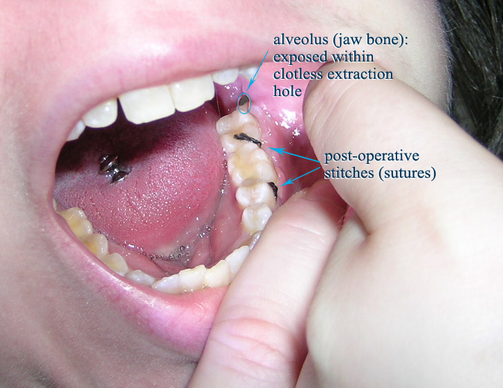 File:Alveolar osteitis labeled dry socket.jpg