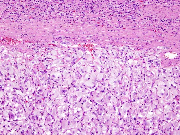 Файл:Adrenal pheochromocytoma (1) histopathology.jpg