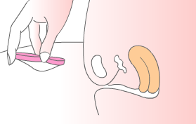 Inserting a thin-walled menstrual disc/ring-shaped cup.[32] Pinching the sides of the cup together and positioning it for insertion.