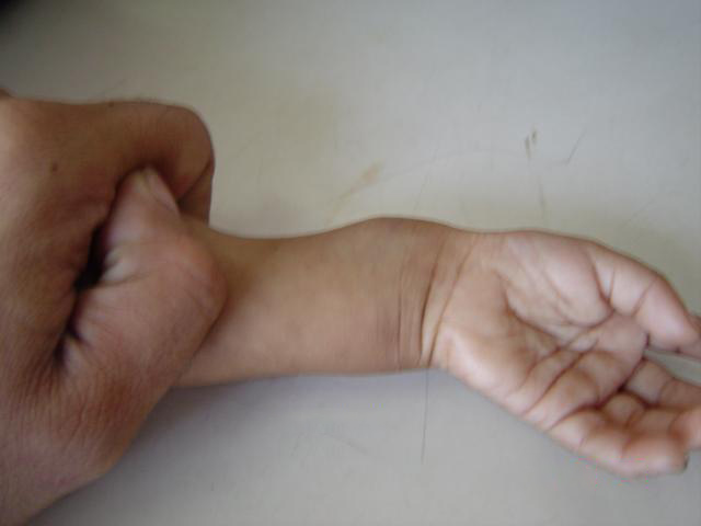 File:Rickets wrist.jpg