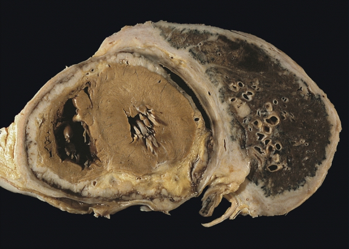 File:Diffuse pleural mesothelioma.jpg