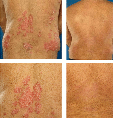 File:Psoriasis infliximab ar1182-2.gif