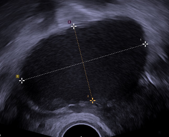 Archivo:Endometrioma.jpg