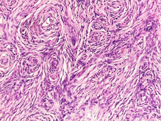 File:Histopathology of neurofibroma.jpg