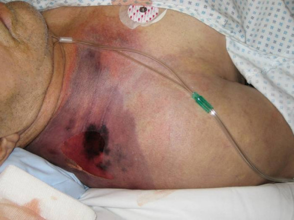 File:Gas gangrene shoulder.jpg