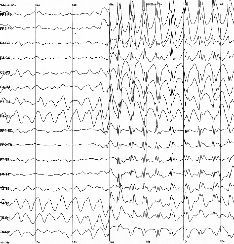 Archivo:Spike-waves.png