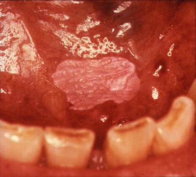 File:NIH DOC 16 HomogenousLeukoplakia.jpg