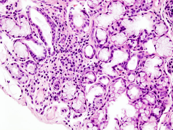 Archivo:Sjogren's syndrome (2).jpg