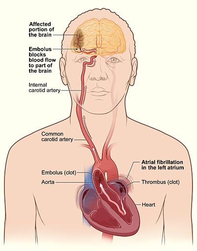 File:Atrial fib stroke.jpg