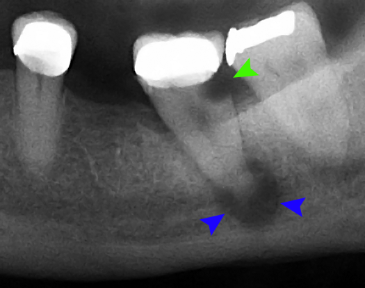 File:Tooth decay and abscess xray.png