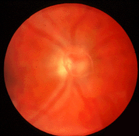 File:Vitreous Floaters.jpg