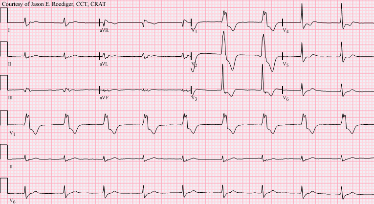 File:AIVR from the LV.png