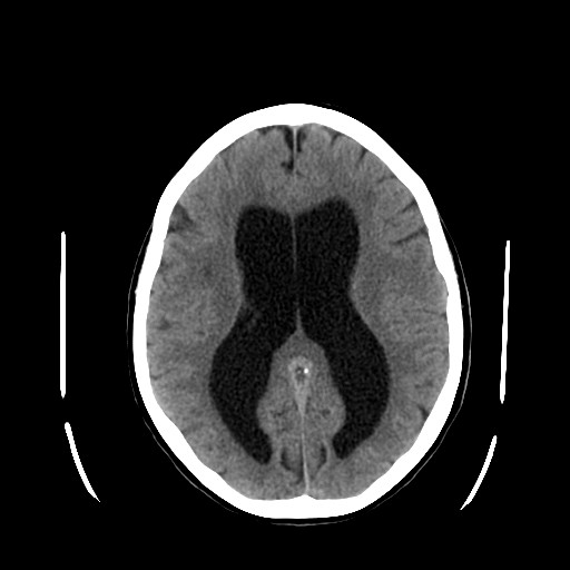 Archivo:Hydrocephalus.jpg