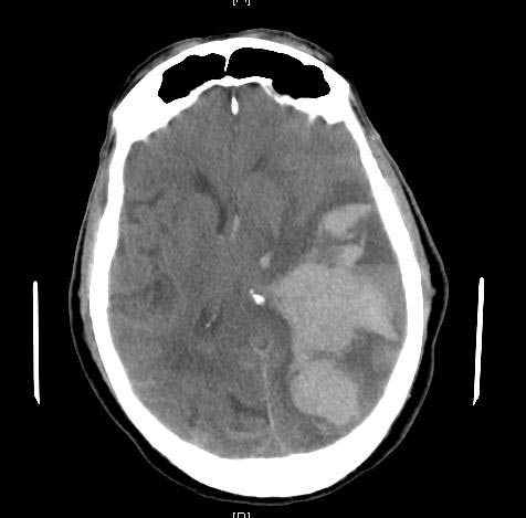 File:Subfalcine-herniation-001.jpg