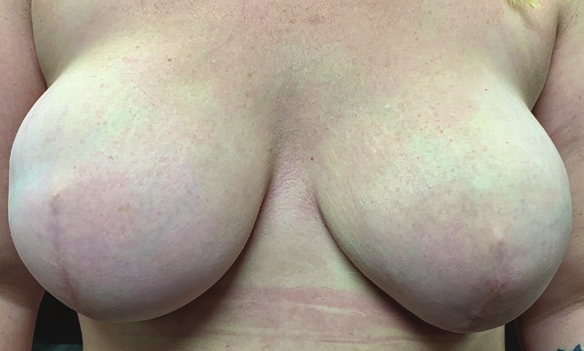 File:Becker Cassisi breasts 1, before.png