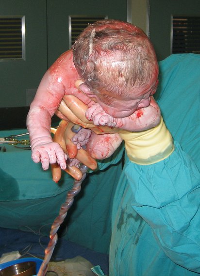 Файл:Caesarian shown cropped.jpg