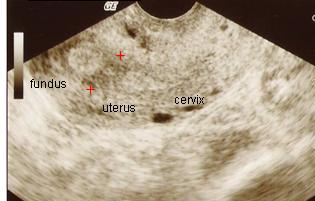 File:Ultrasound of Asherman's syndrome.jpg