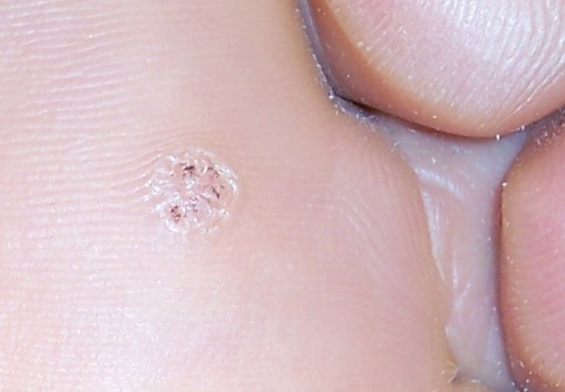 Файл:Veruca right foot detail.jpg