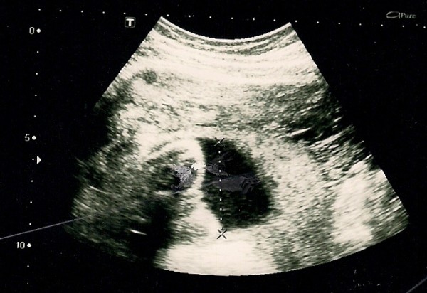 File:Ultrasonography of abdominal pregnancy.jpg