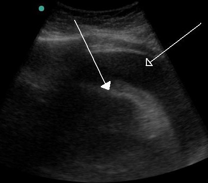 File:Hemorragic effusion.jpg