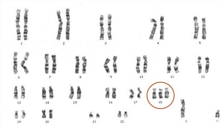 File:Trisomia 18.jpg