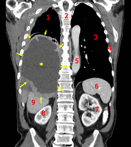 Archivo:Tumor Mesothelioma2 legend.jpg