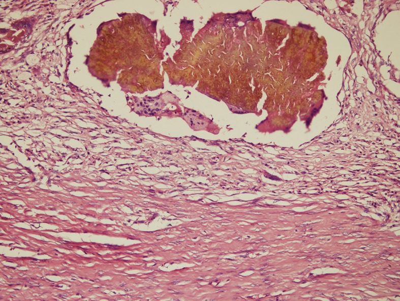 File:M. mycetomatis cytological smear.jpg