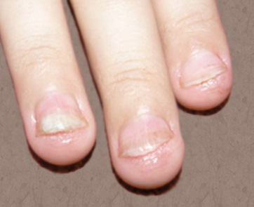 Файл:Candida nails2012.jpg