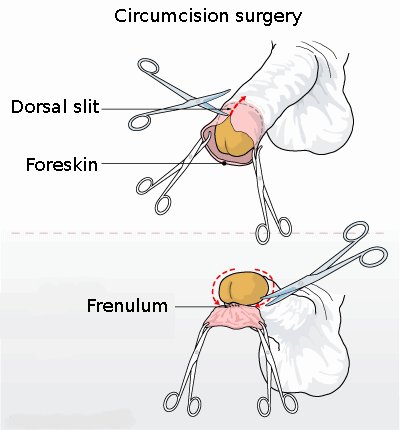 File:Circumcision illustration.jpg