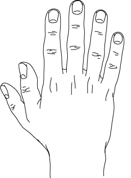 File:Polydactyly preaxial.gif