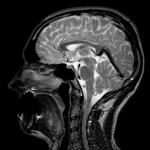 Файл:Head MRI, enlarged inferior sagittal sinus.png