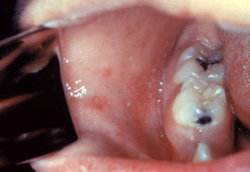 Файл:Koplik spots, measles 6111 lores.jpg