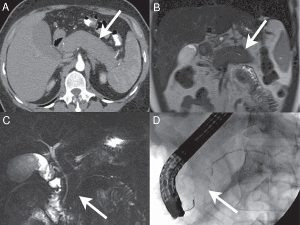 File:Diffuse autoimmune pancreatitis.jpg