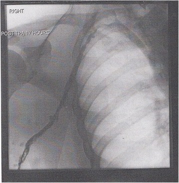 After treatment with catheter-directed thrombolysis, blood flow in the axillary and subclavian vein were significantly improved. Afterwards, a first rib resection provided thoracic outlet decompression to reduce the risk of recurrent DVT and the risk of sequelae from thoracic outlet compression.[110]