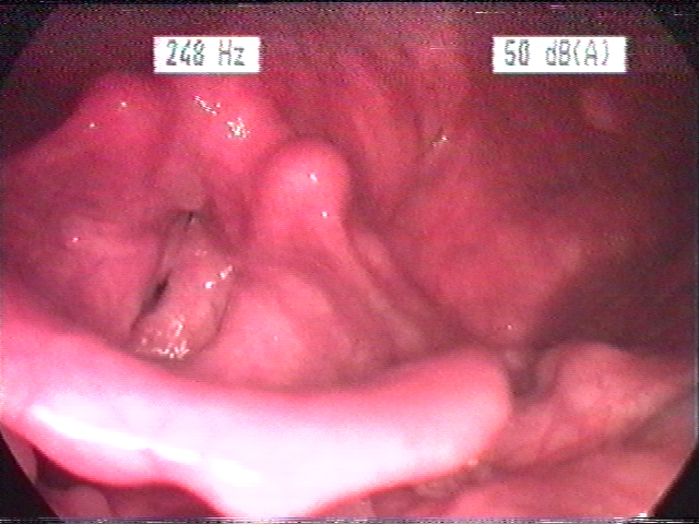 File:Laryngitis gastrica.jpg