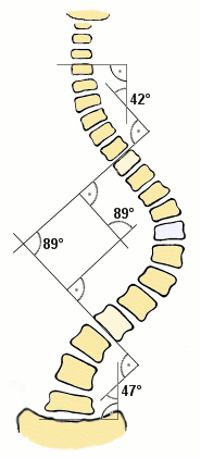 File:Scoliosis cobb.gif