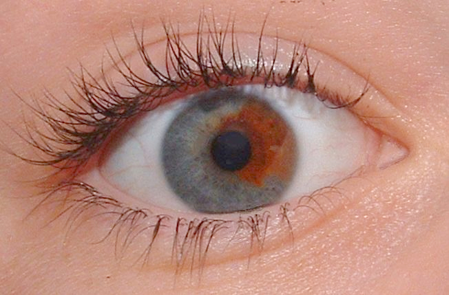 File:HeterochromiaEye.jpg