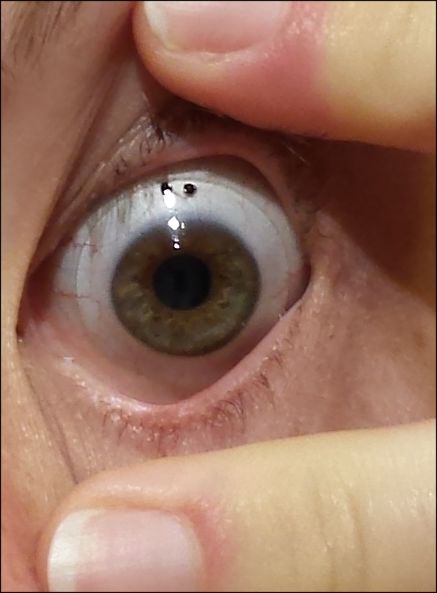 File:Scleral lens worn on an eye.jpg