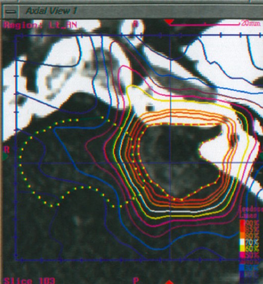 File:Acoustic schwannoma gamma knife.jpg