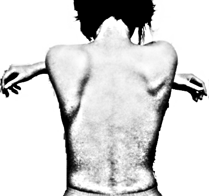 File:Winging scapula.jpg