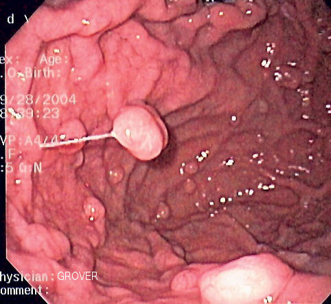 Файл:Fundic gland polyposis0001.jpg