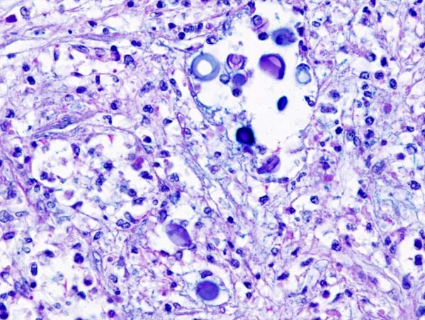 File:Pulmonary cryptococcosis (3) Alcian blue-PAS.jpg