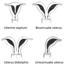 Файл:Uterine malformation.jpg