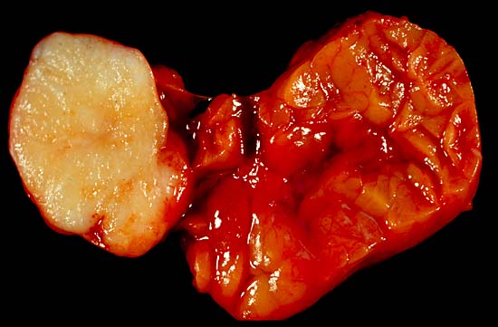 File:Mixed Tumor of the Salivary Gland.jpg